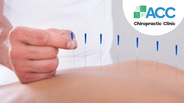 Hình ảnh châm cứu điều trị thoái hóa cột sống