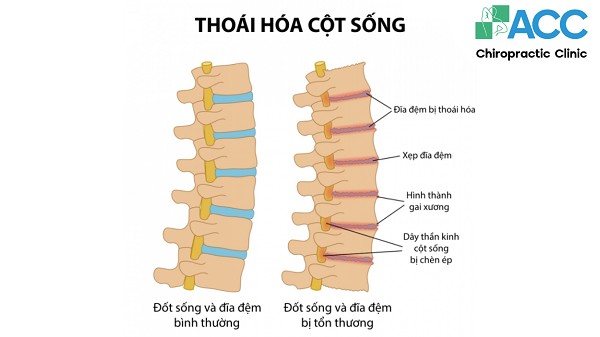 Thoái Hóa Là Gì? Nguyên Nhân Nào Gây Ra Hiện Tượng Thoái Hóa?